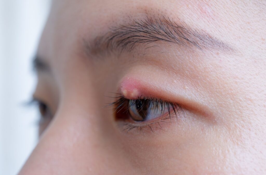 A person with a stye on their upper right eyelid looks left.
