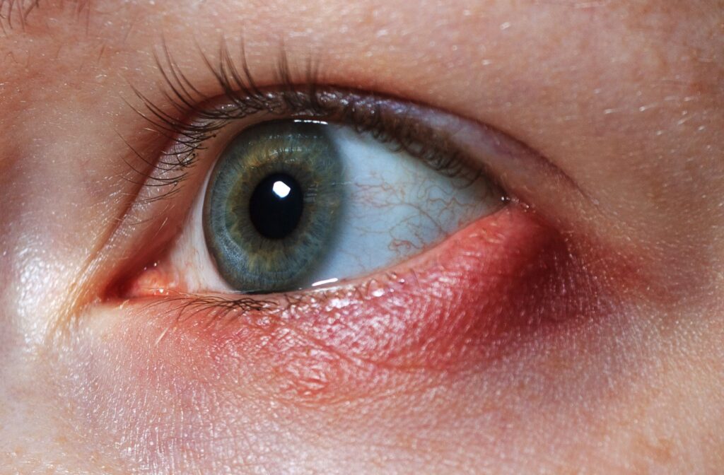 A close-up image of a person's eye with a stye on the lower right eyelid.