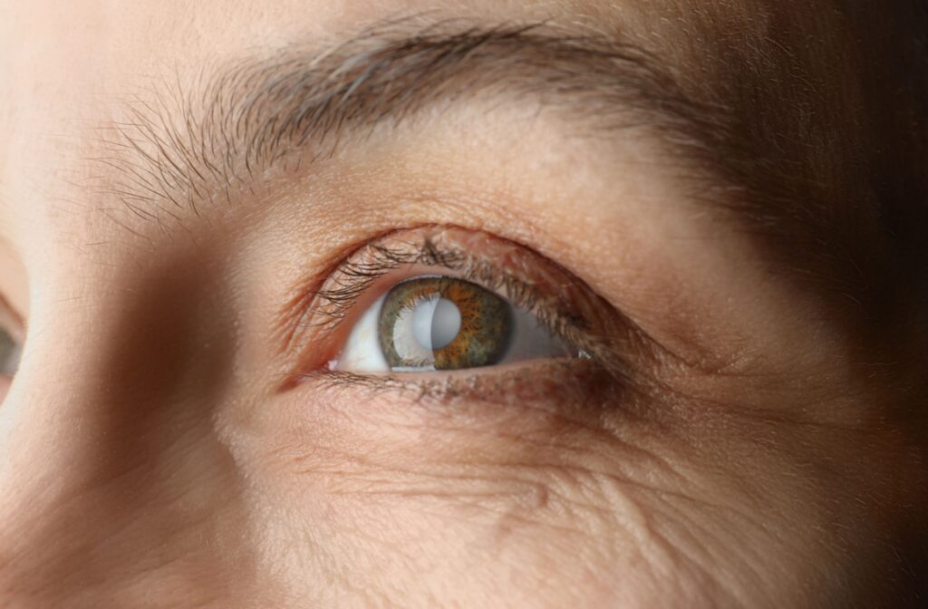 Close-up of a senior person's eye showing a cloudy center, illustrating the presence of cataracts.